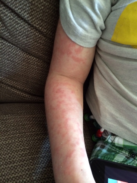GVHD rash on his arm